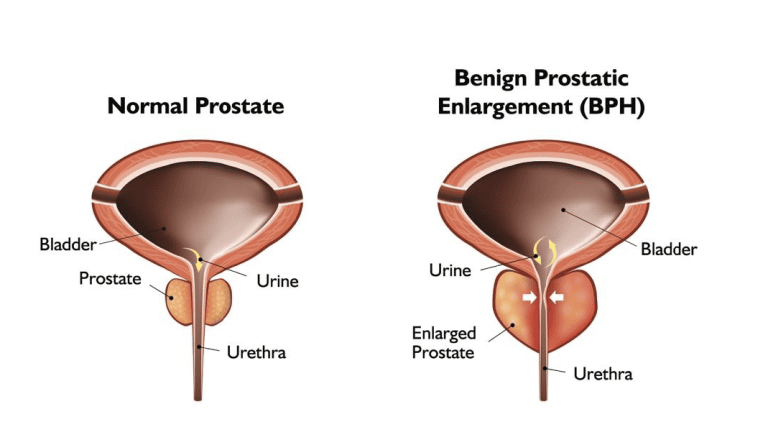 Normal Prostate vs. Enlarged Prostate
